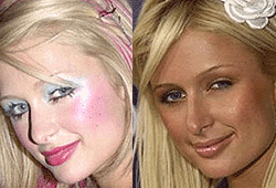 Paris Hilton ended up with a downturned nose after rhinoplasty surgery.