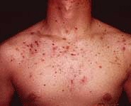 Everyone would love to get rid of their pimples!