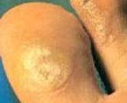 Find out how you can get rid of pesky warts!