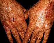 Skin cancer can be caused by experiencing sunburns throughout your life.
