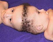 While most conjoined twins are joined at the chest, these Siamese twins from Egypt are joined at the head.