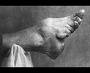 Deformed foot that had been bound.