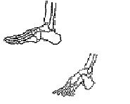 Normal foot compared to bound foot.