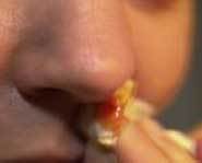 Nosebleeds usually start from one nostril.