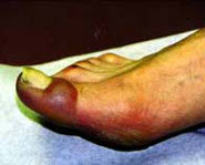 Frostbite can cause blistering, swelling and pain!