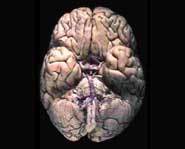 A concussion is a rocking of the brain.