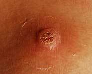 An extreme closeup of a nasty wart.