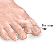 A person with hammertoes has toes that are curled up until they're practically vertical.