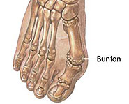Bunions are passed down from your parents cuz you tend to have the same foot shape as them.
