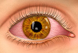 Pink eye is an eye infection that turns your eyes pink or red.