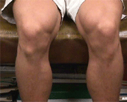 Osgood Schlatter Disease is one of the most common causes for knee pain in kids and young adults.