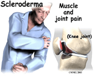 Scleroderma Affects 20 Out of Every 100,000 People