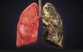 Lungs after smoking cancer